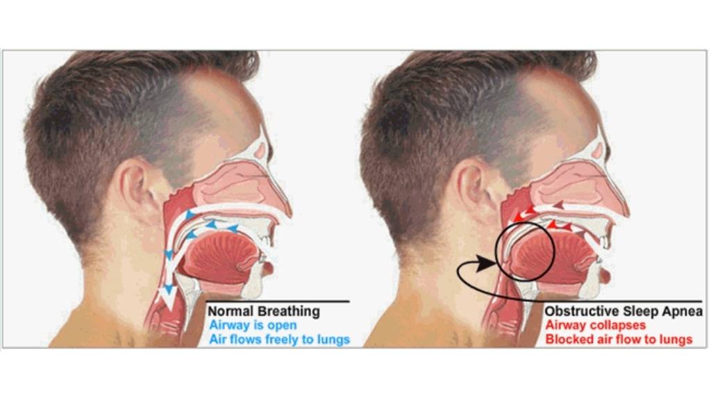 obstructive sleep apnea