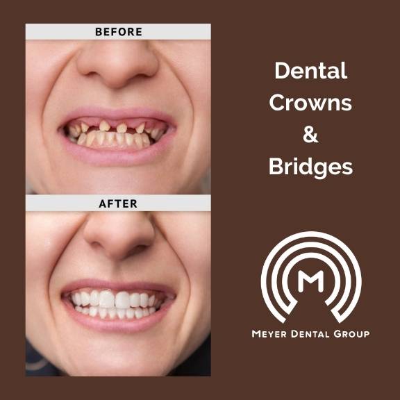 Dental crowns and bridges in mt prospect