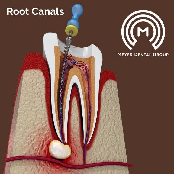 root canal therapy mount prospect