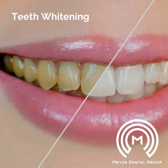 teeth whitening dentist mount prospect
