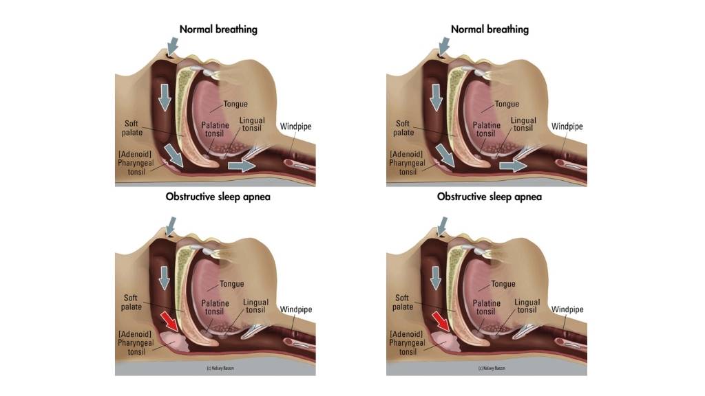 obstructive sleep apnea