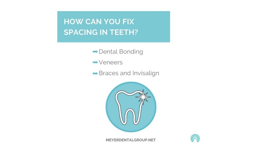 teeth space