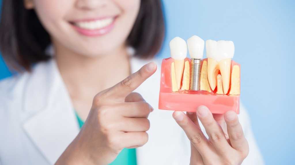 Dental implants mount prospect jaw bone