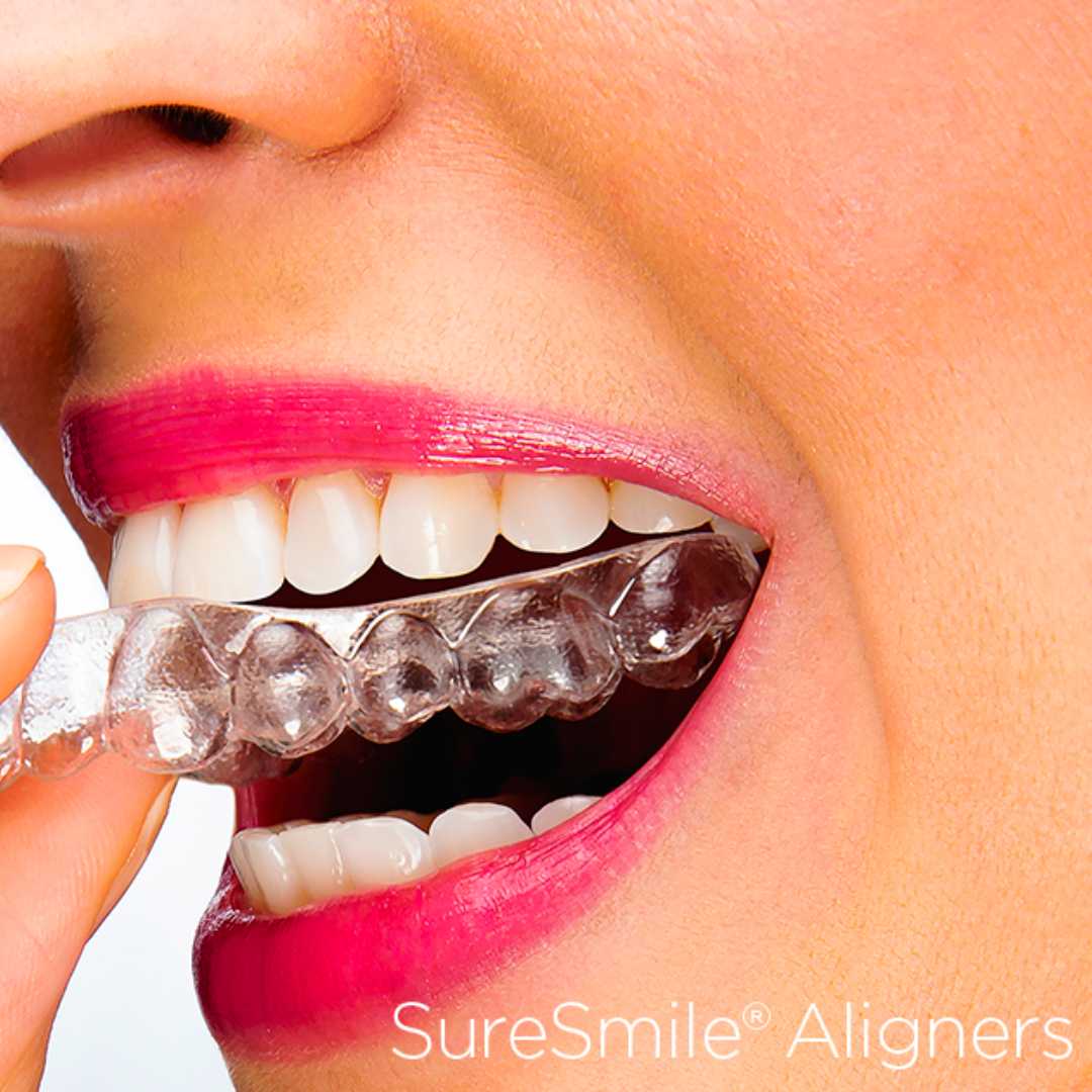 suresmile aligners