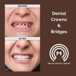 geo-dental-crowns-bridges-mt-prospect